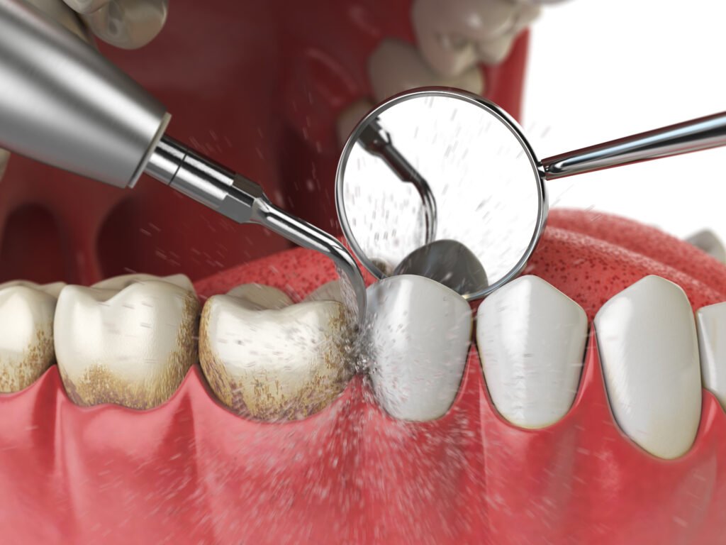 Limpeza profissional dos dentes. Máquina de limpeza ultrassônica de dentes exclui cálculo dentário de dentes humanos.