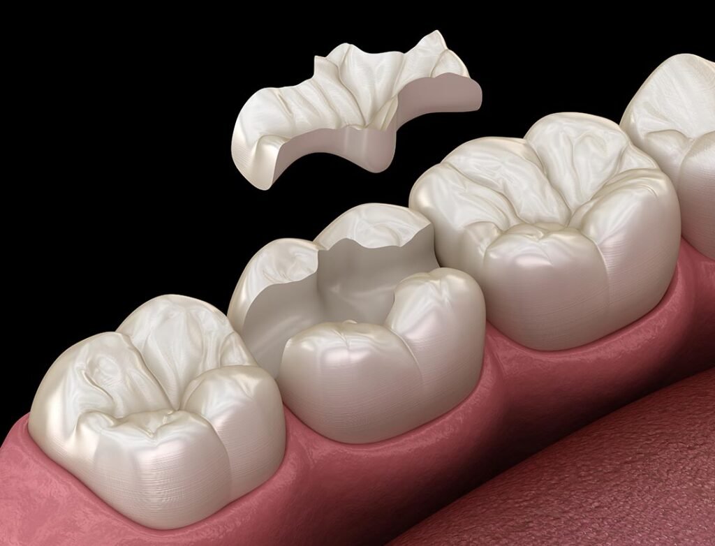 Inlay ceramic crown fixation over tooth. Medically accurate 3D illustration of human teeth treatment