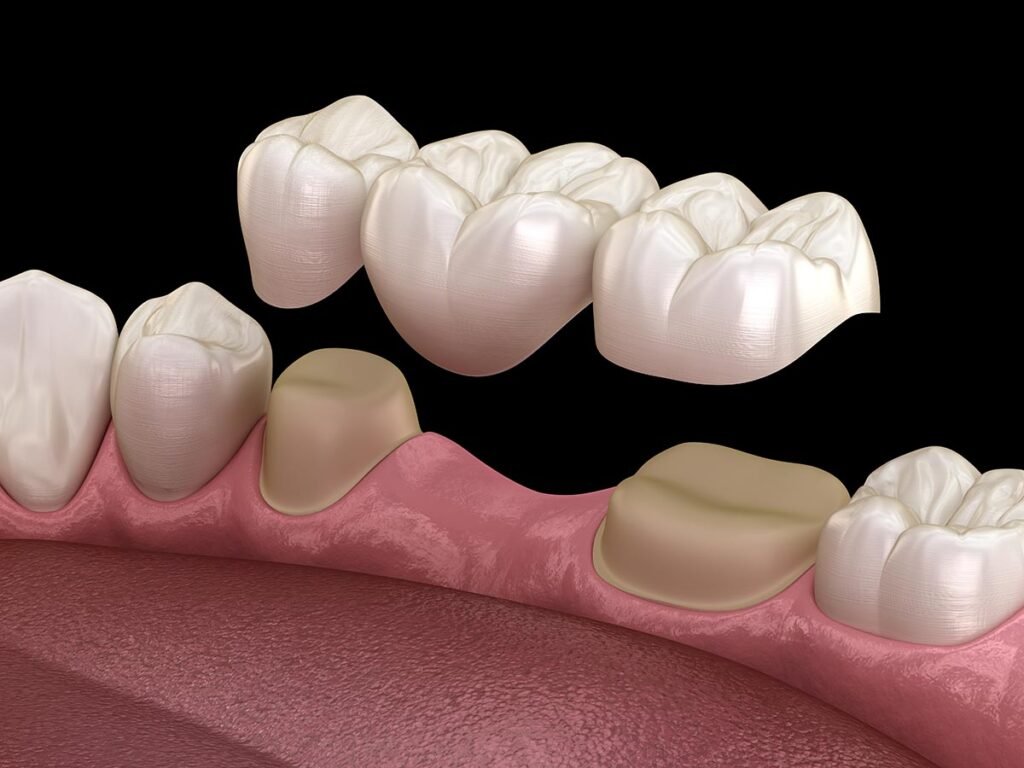 Dental bridge of 3 teeth over molar and premolar. Medically accurate 3D illustration of human teeth treatment