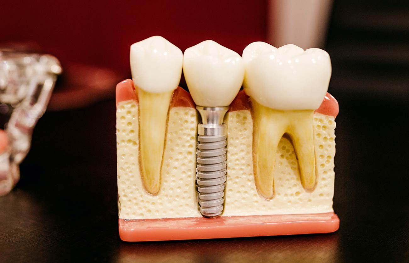 Próteses Dentárias. Entenda como é o procedimento.