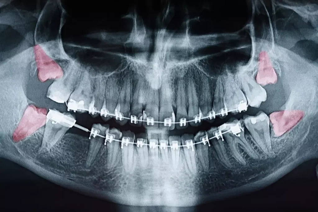 Raio x mostrando aparelho dental