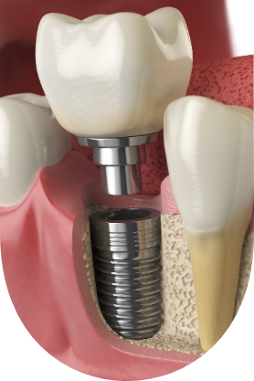 Ilustração de implante dentario